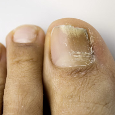 Micosi unghie piedi